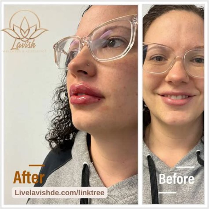 
Has Lil Kim Done Botox And Lip Fillers? Her Before And After Photos 